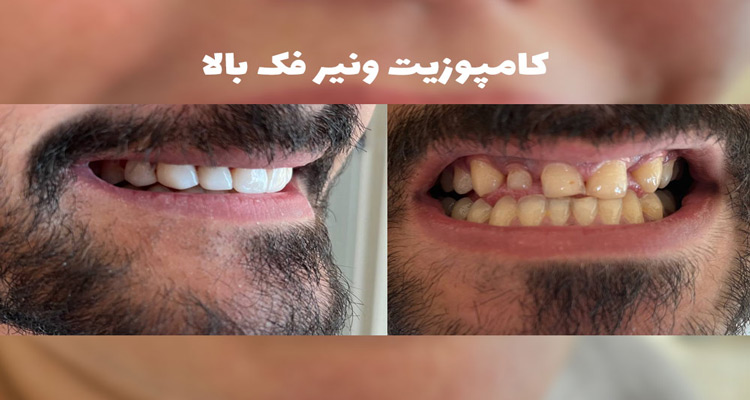 نمونه کار کامپوزیت دندان کلینیک دکتر مریم محمدی