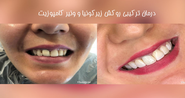 نمونه کار کامپوزیت دندان کلینیک دکتر مریم محمدی