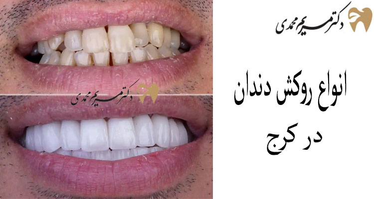 ترمیم دندان با روکش در کلینیک دکتر مریم محمدی در کرج