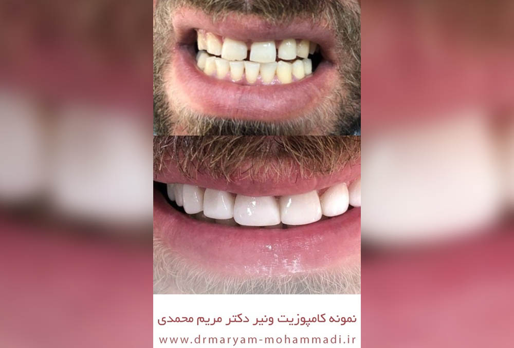 ترمیم دندان با کامپوزیت ونیر در کلینیک دکتر مریم محمدی در کرج