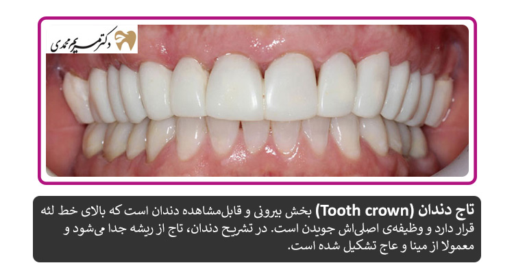 تاج دندان