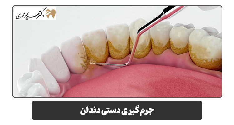 جرم گیری دستی دندان 