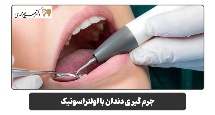 جرم گیری دندان با اولتراسونیک