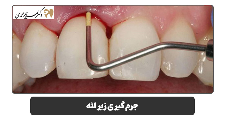 جرم گیری زیر لثه