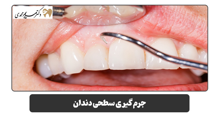 جرم گیری سطحی دندان