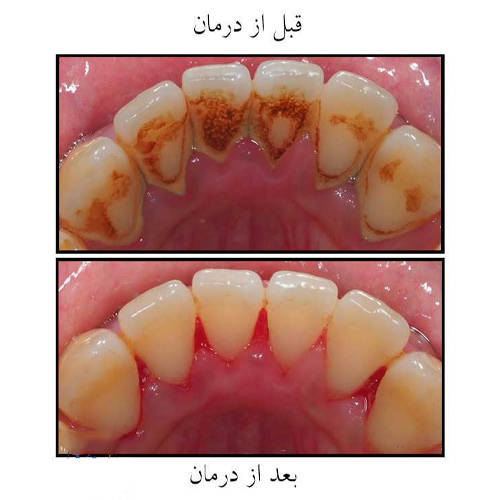 قبل و بعد از جرمگیری دندان