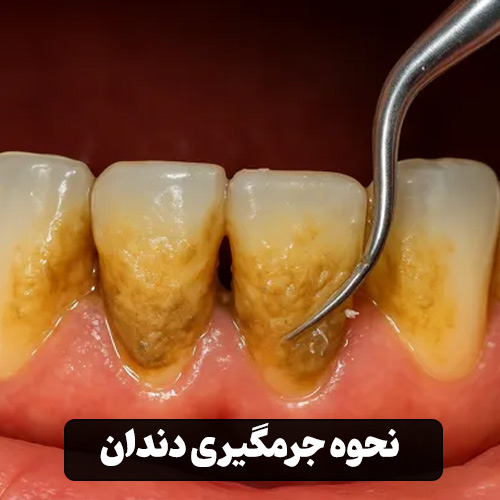 نحوه جرمگیری دندان
