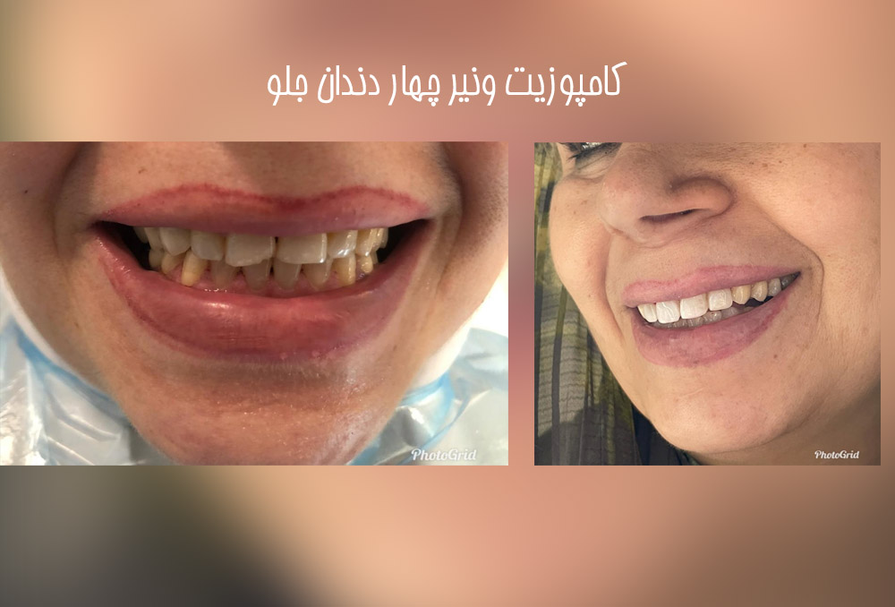 نمونه کار کامپوزیت دندان دکتر مریم محمدی