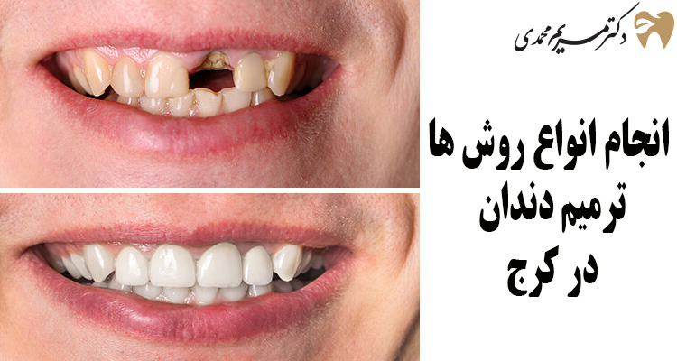 هزینه ترمیم دندان در کرج
