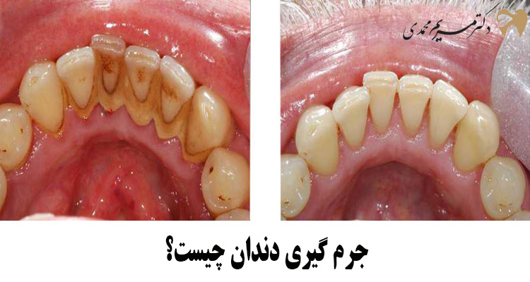 جرم گیری دندان در کرج