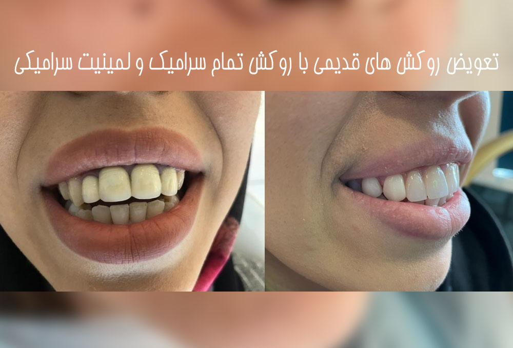 نمونه لمینت دندان در طالقانی کرج