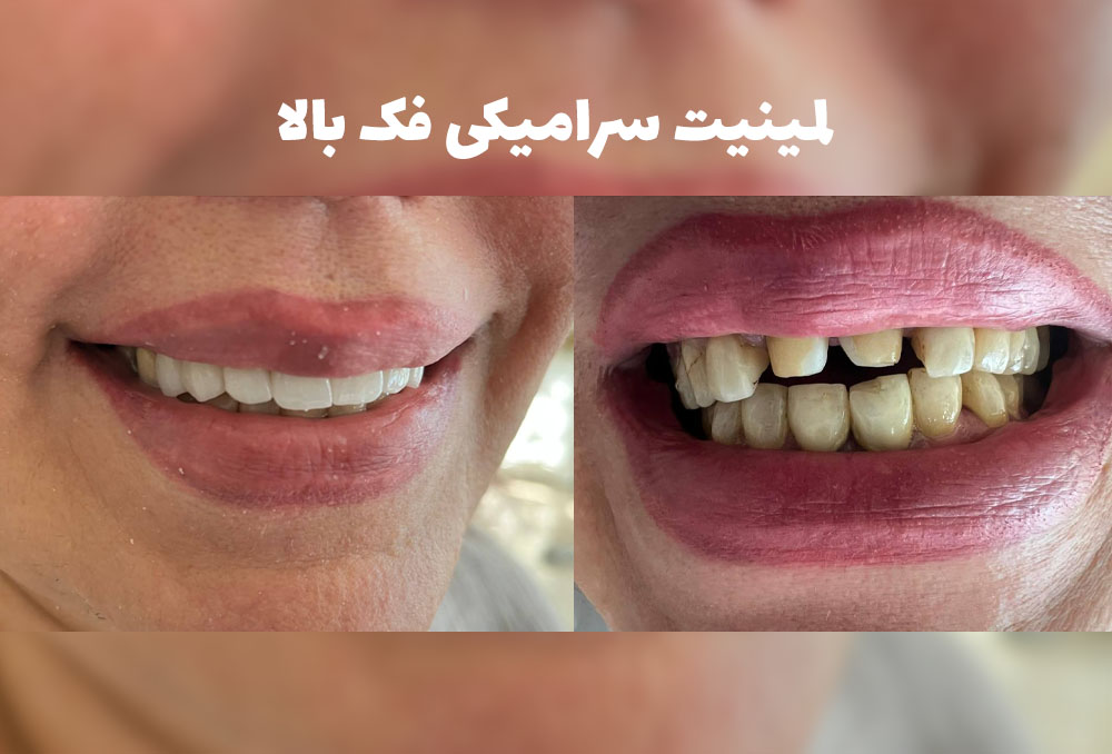 نمونه لمینت دندان در طالقانی کرج
