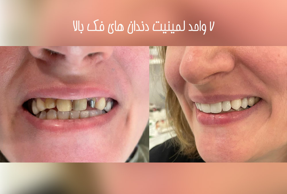 نمونه لمینت دندان در آزادگان