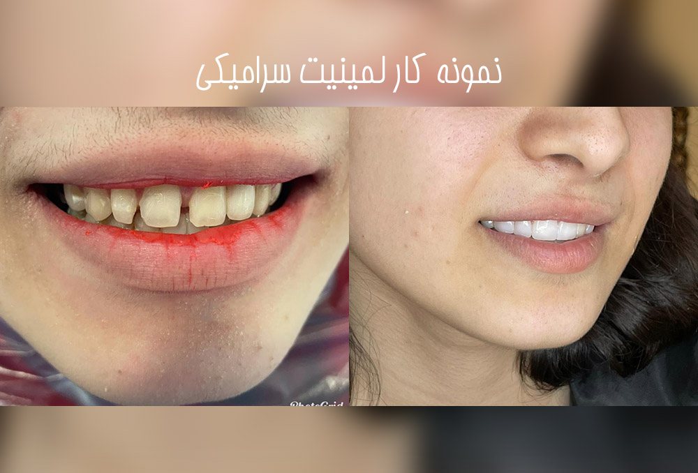 نمونه لمینت دندان در آزادگان