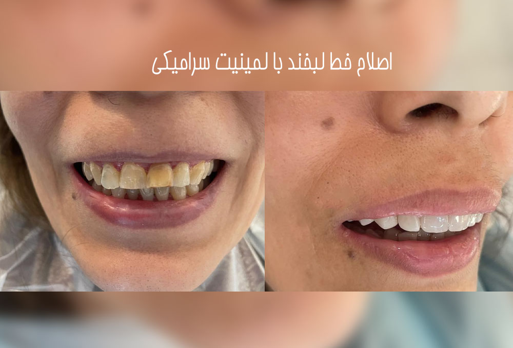نمونه لمینت دندان در عظیمیه کرج