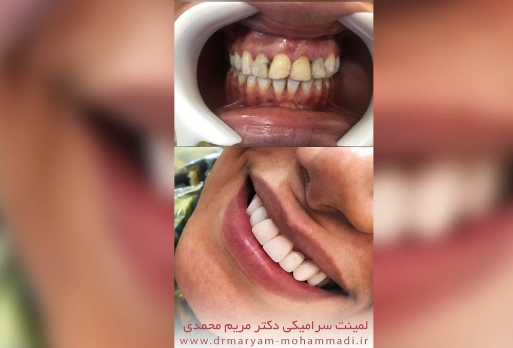 نمونه لمینت دندان در عظیمیه کرج