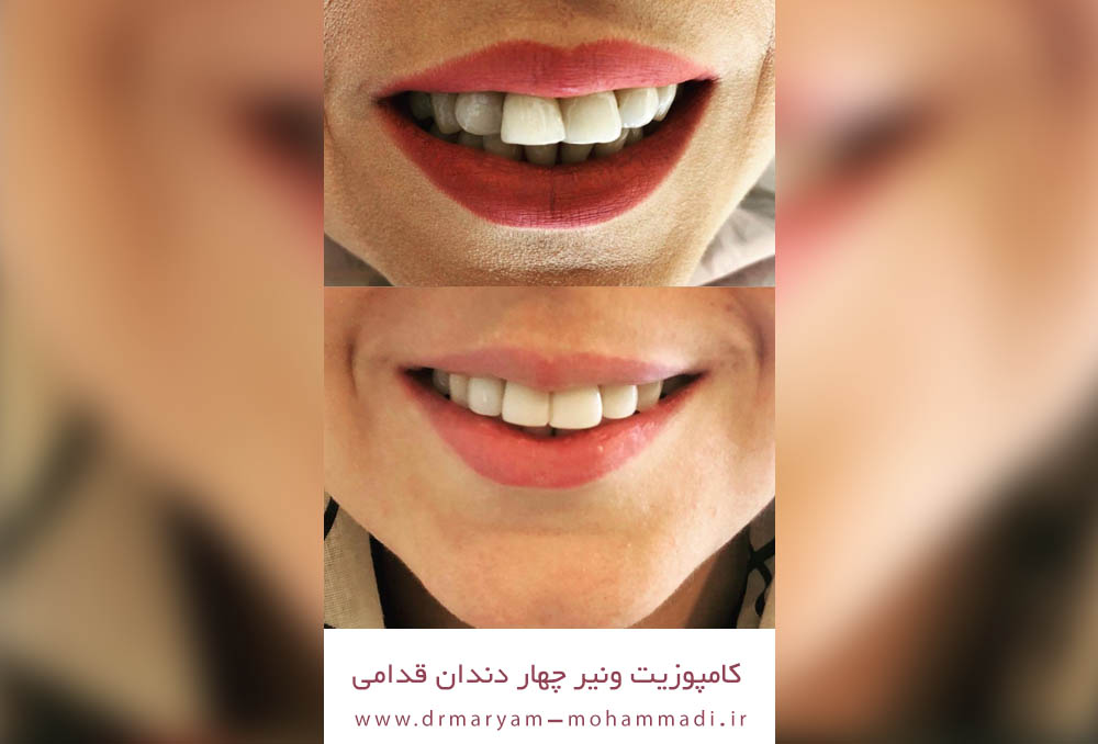 نمونه کامپوزیت دندان در هفت تیر کرج