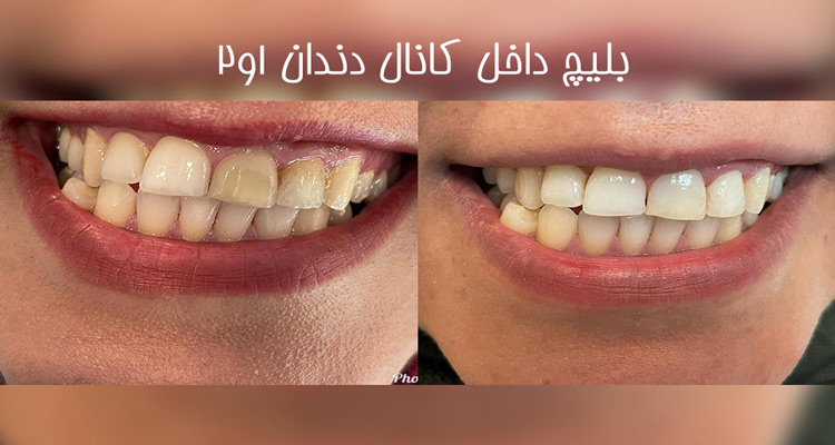 عکس قبل و بعد بلیچینگ دندان در جهانشهر
