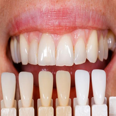لمینت و کامپوزیت در کرج