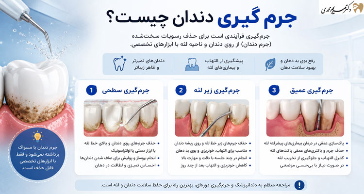 آشنایی با جرم گیری دندان و انواع آن
