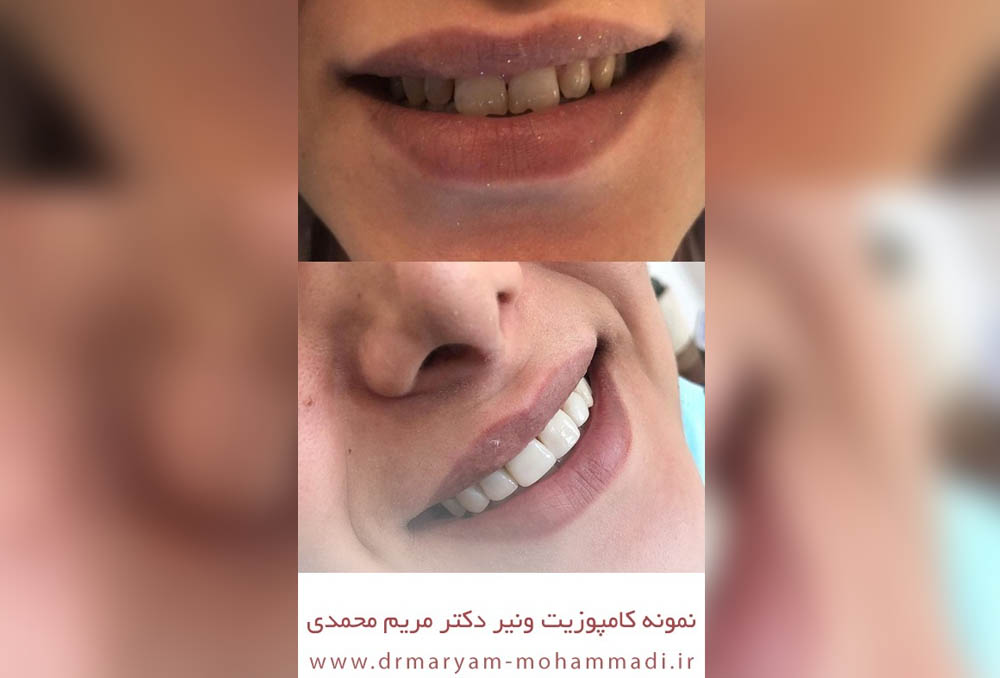 نمونه کار کامپوزیت ونیر دکتر محمدی