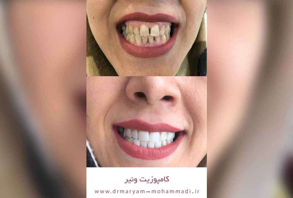 نمونه کارهای کامپوزیت دندان در کرج 