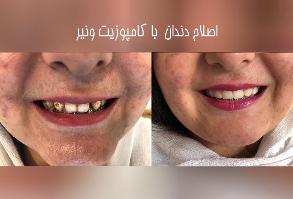 نمونه کارهای کامپوزیت دندان در کرج 