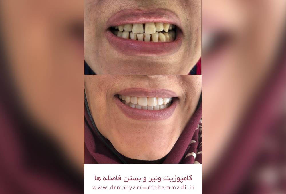 نمونه کارهای کامپوزیت دندان در کرج 