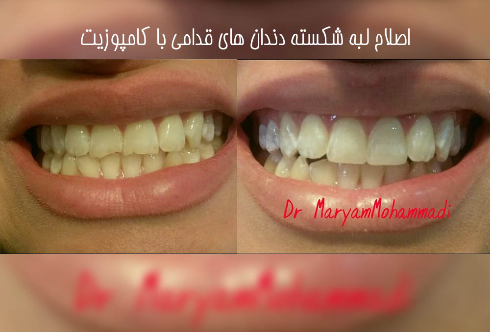 نمونه کارهای کامپوزیت دندان در کرج 