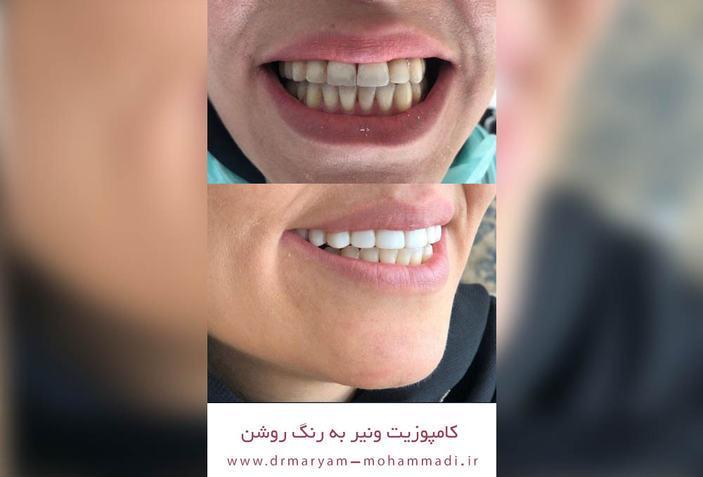 نمونه کارهای کامپوزیت دندان در کرج 