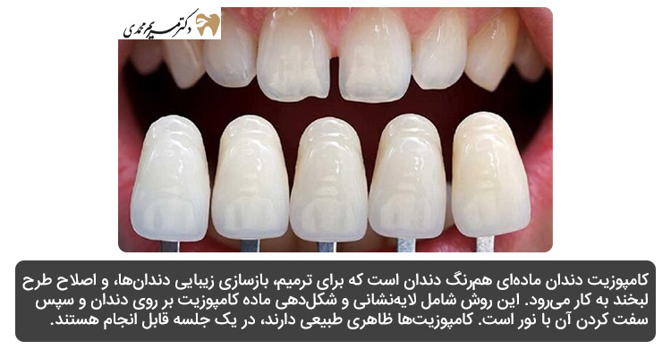 کامپوزیت دندان چیست