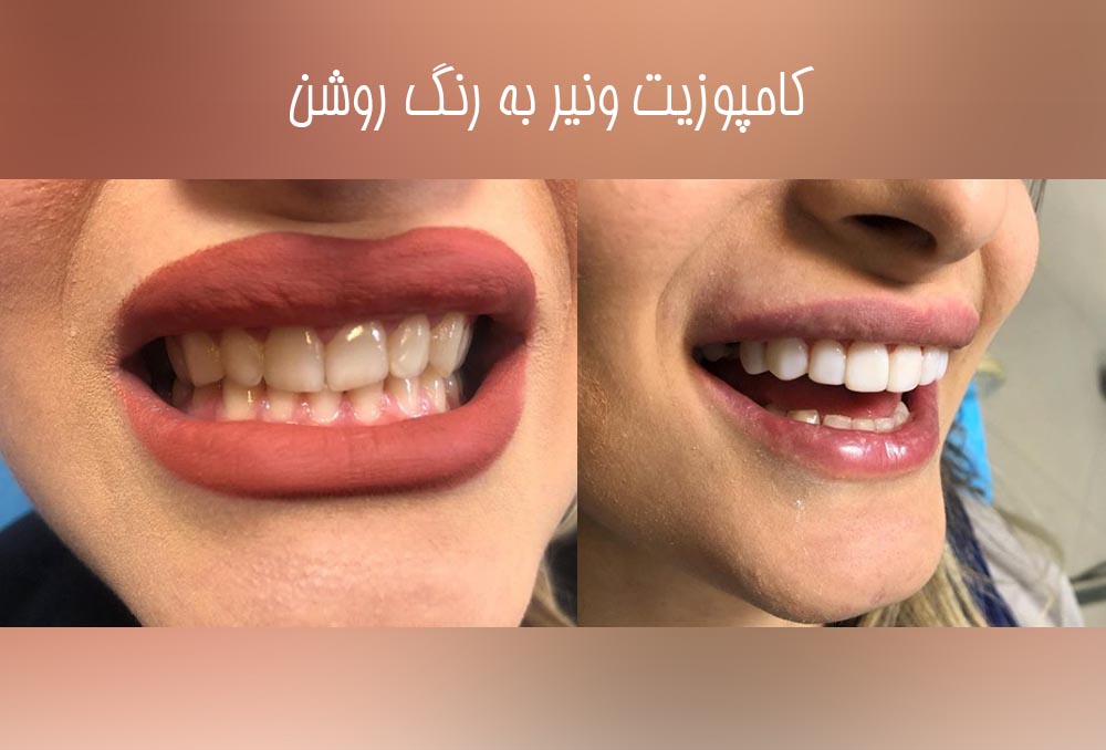 کامپوزیت ونیر به رنگ روشن
