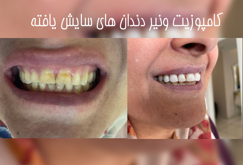 کامپوزیت ونیر دندانهای سایش یافته