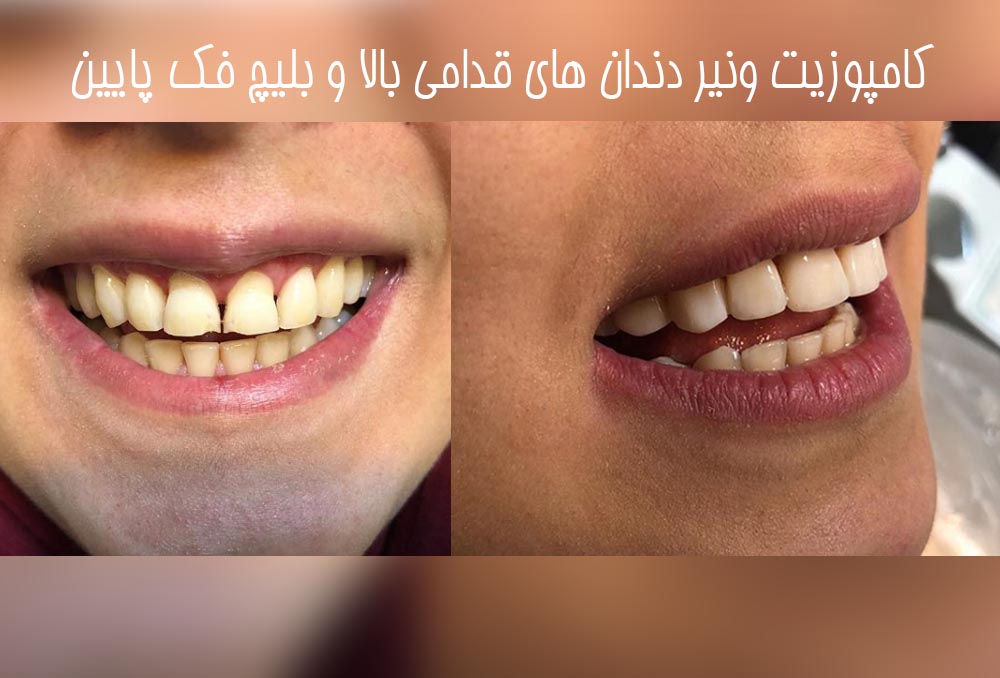 کامپوزیت ونیر دندانهای قدامی بالا