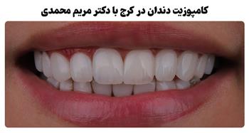 کامپوزیت دندان در کرج (قیمت کامپوزیت از 4 میلیون)
