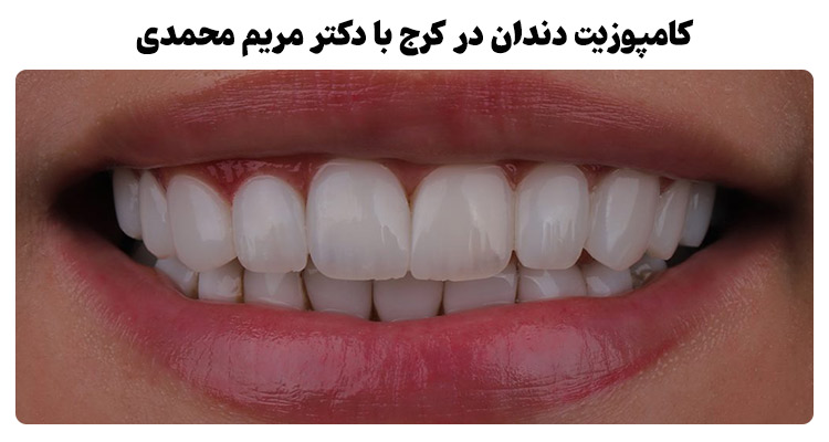 کامپوزیت دندان در کرج