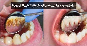 جرم گیری دندان چگونه انجام می‌شود؟ مراحل، ابزارها و مراقبت‌های بعد از آن