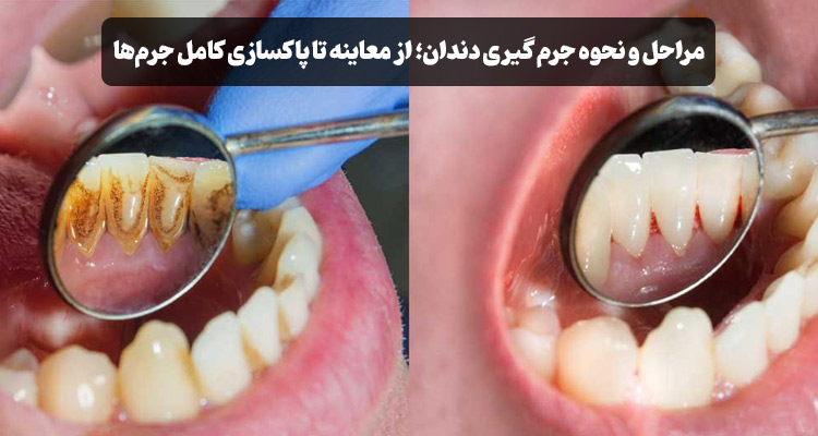 مراحل و نحوه جرم گیری دندان