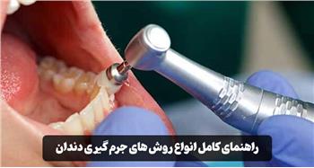 انواع روش های جرم گیری دندان | بررسی کامل مزایا و تفاوت‌ها