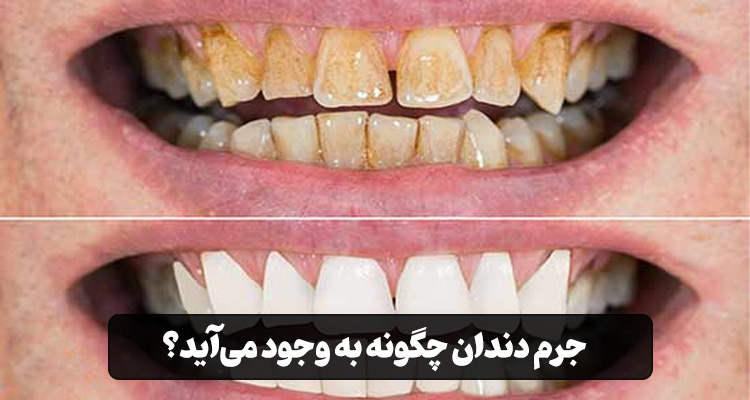 جرم دندان چیست