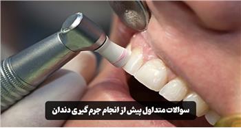 سوالات متداول پیش از انجام جرم گیری دندان