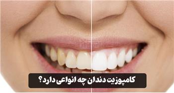 کامپوزیت دندان چه انواعی دارد؟ مقایسه انواع آن، مزایا و معایب هرکدام