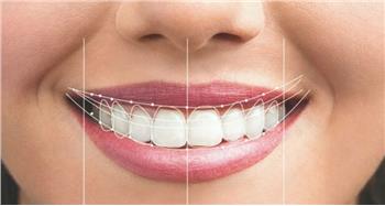 آیا دندان روکش شده را میتوان لمینت کرد؟