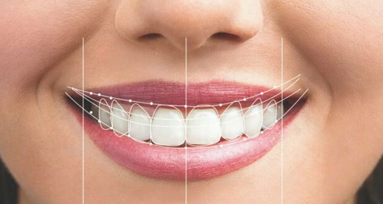 آیا دندان روکش شده را میتوان لمینت کرد؟
